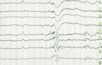 Epilepsie