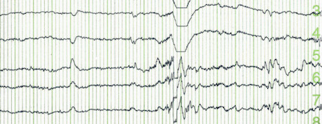Epilepsie